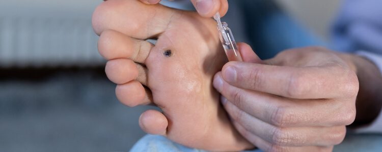 Person removing wart from foot sole using surgical liquid.
