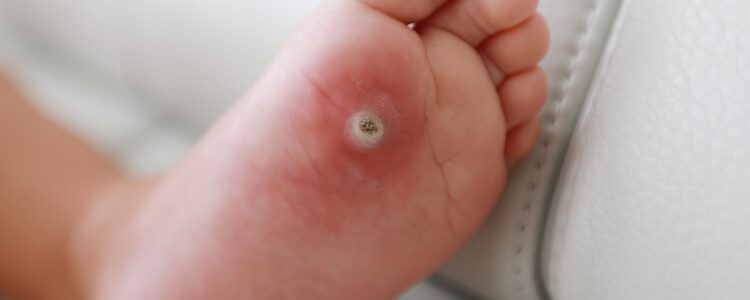 Single plantar wart with white center on foot sole
