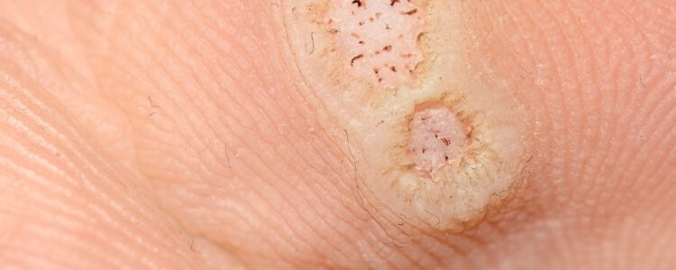 Close-up of small circular warts or lesions on skin
