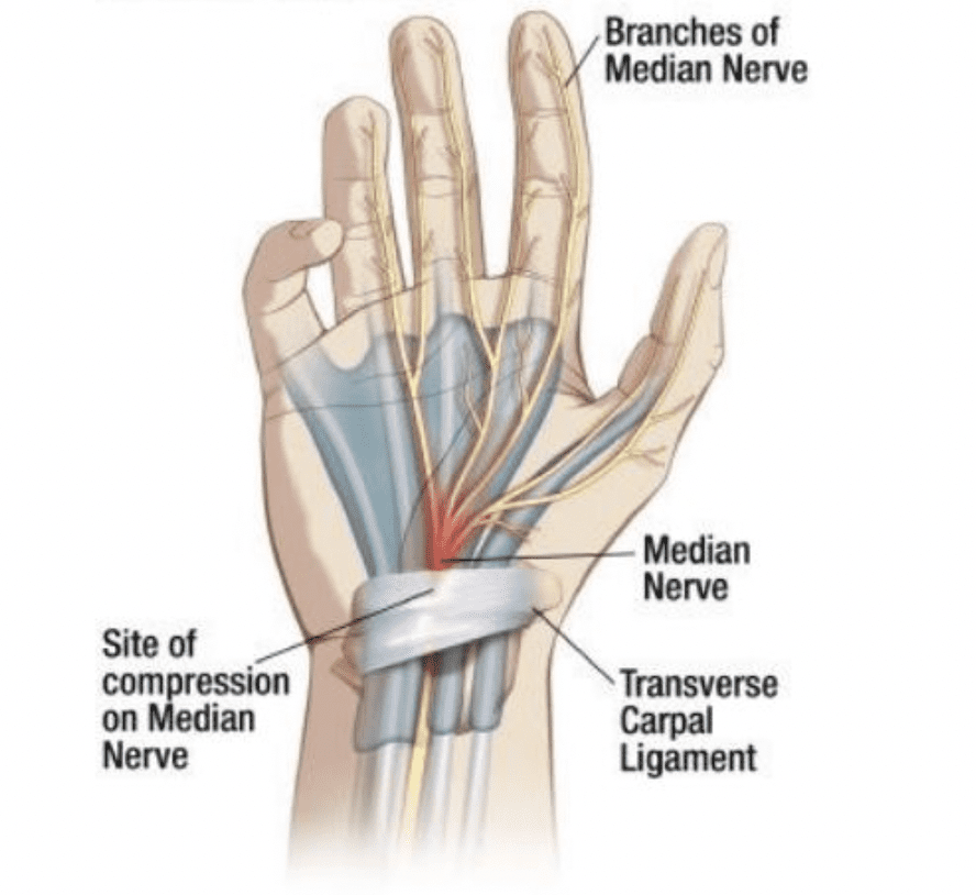 Срединный нерв. Карпальный туннельный синдром. Карпальный туннельный синдром запястья. Карпальный синдром лучезапястного сустава. Туннельный синдром лучезапястного сустава.