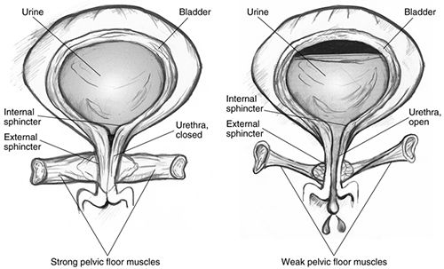 pelvic floor physiotherapy and incontinence