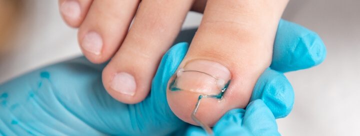 Ingrown toenail removal