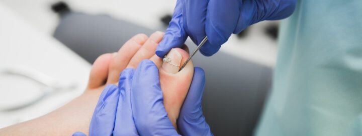  lifting out ingrown toenail