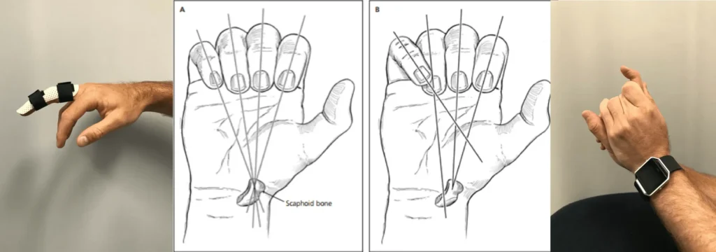 Finger Fractures