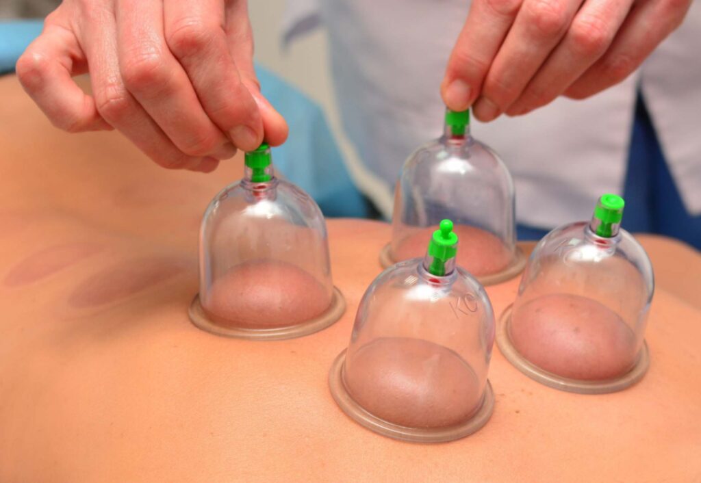 Myofascial Cupping, what is it?